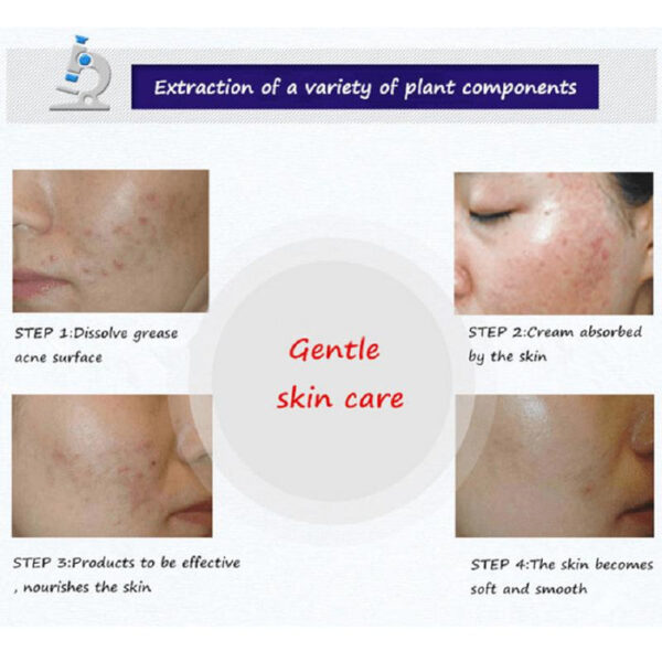 BIOAQUA Anti Acne Cleanser For Removal Of Acne 100ml - Image 3